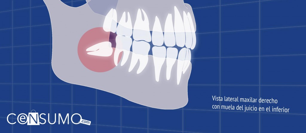 ilustración de vista lateral maxilar derecho con muela del juicio en el inferior