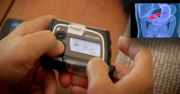 EConoce el primer páncreas artificial para pacientes con diabetes tipo 1