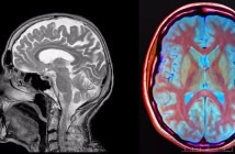 Interleukin-1, la droga revolucionaria contra el daño cerebral