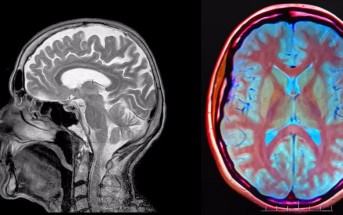 Interleukin-1, la droga revolucionaria contra el daño cerebral