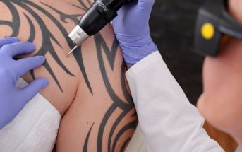 ¿Cómo funciona la eliminación de un tatuaje mediante el láser?