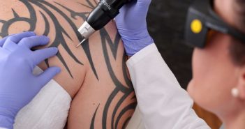 ¿Cómo funciona la eliminación de un tatuaje mediante el láser?