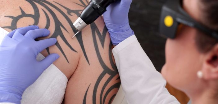 ¿Cómo funciona la eliminación de un tatuaje mediante el láser?